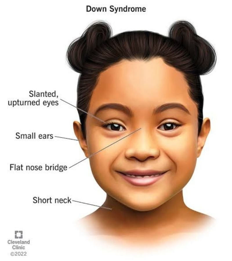 Down Syndrome Image